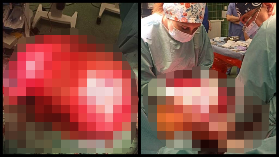Zielonogórscy lekarze wycięli gigantycznego guza z brzucha kobiety. Ważył więcej niż pacjentka!